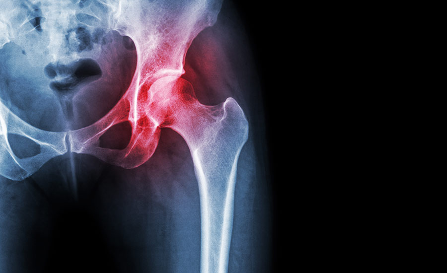 common hip injuries
