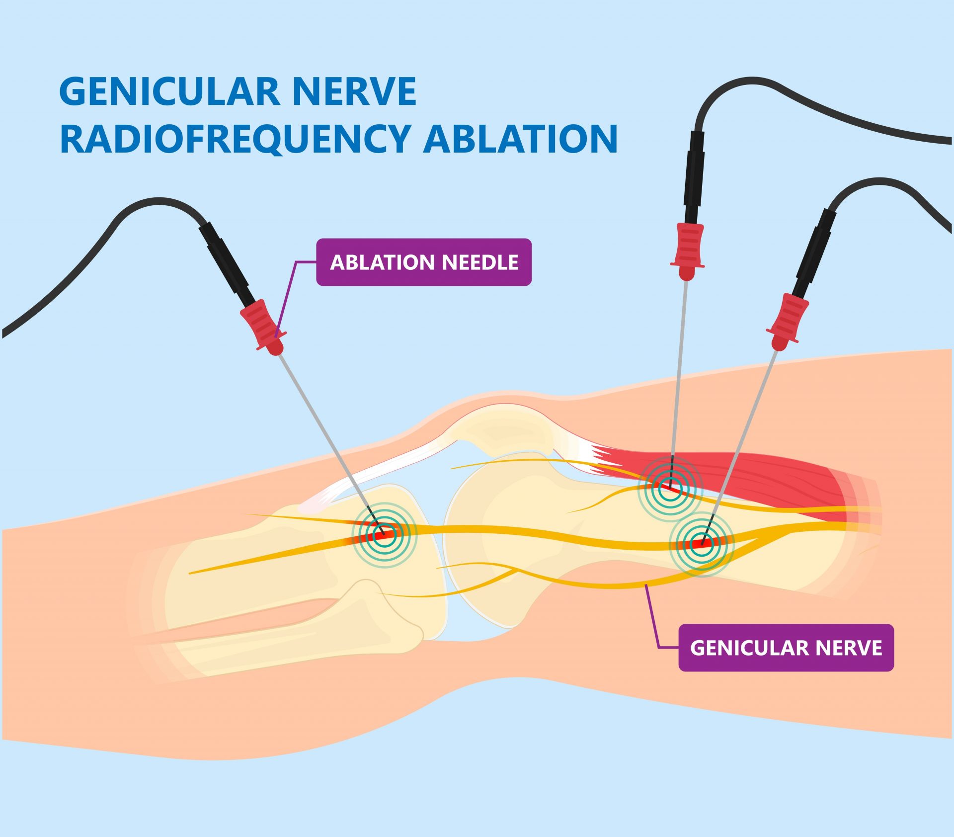 Radiofrequency Ablation Treatment OrthoEast radiofrequency-ablation-treatment-orthoeast